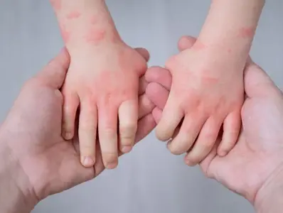 Allergie Hände Allergie Hände